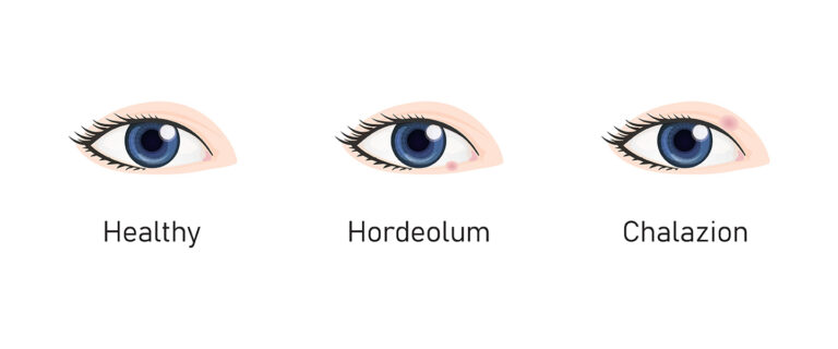 illustrations of a healthy eye vs an eye with a stye and an eye with a chalazion