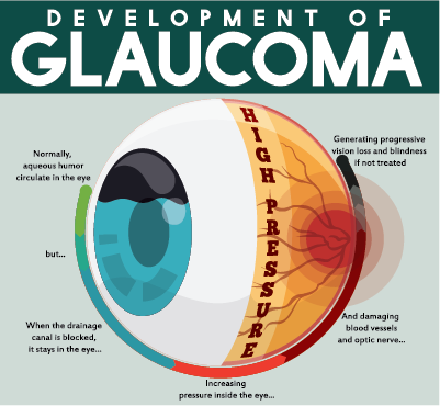Infographic showing development of glaucoma via fluid buildup in the eye increasing pressure and damaging the optic nerve