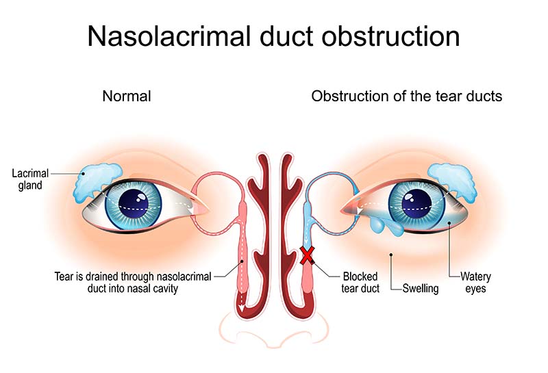 Nasolacrimal duct obstruction diagram