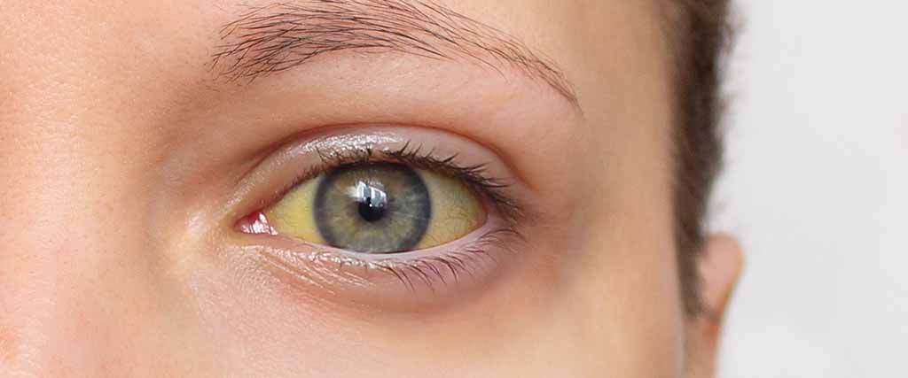 Closeup of an eye with yellowing.